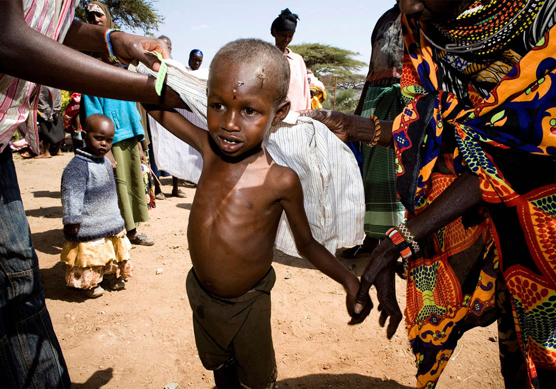 A colour image of a young malnourished boy East Africa Appeal supported by The Ellis Campbell Foundation